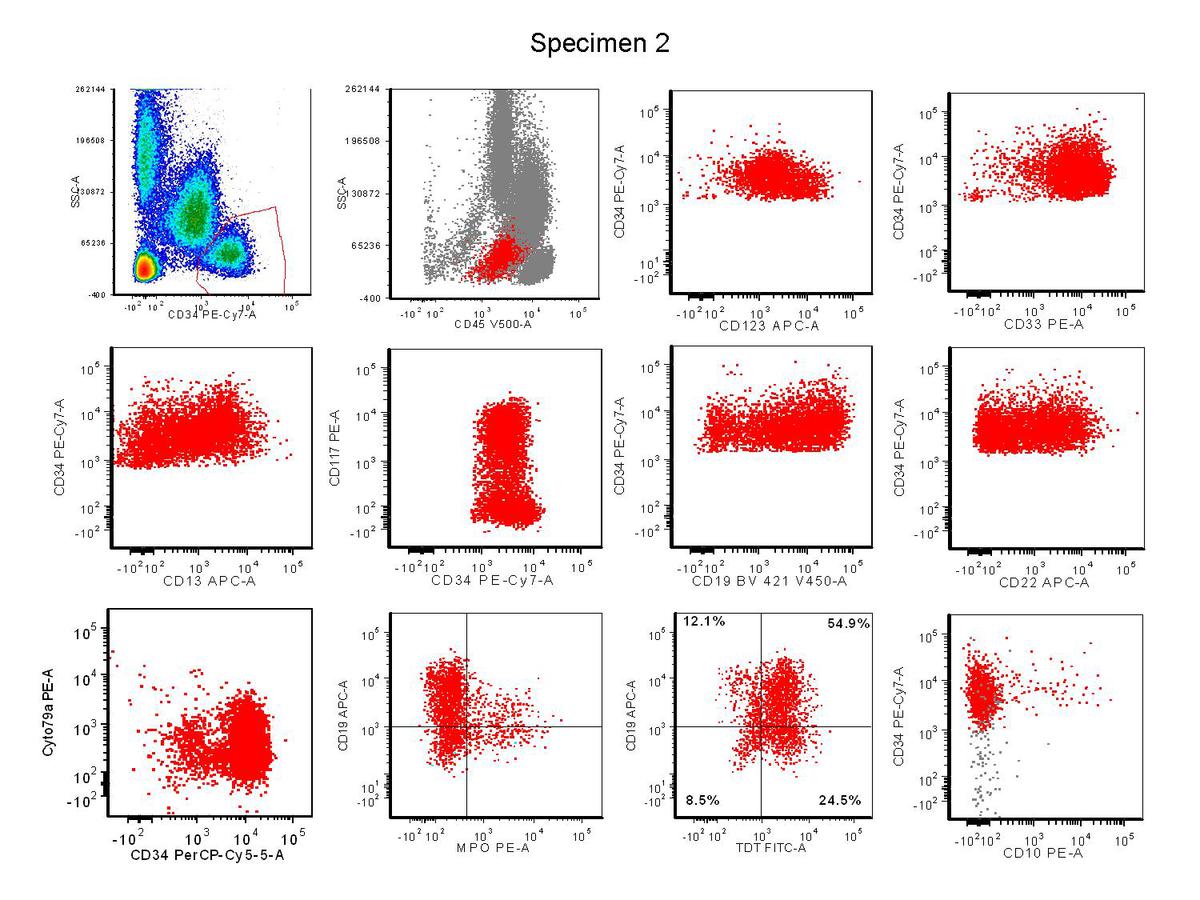 Figure 4. Review of flow cytometric results on specimen 2 that showed 13% blasts (dim CD45) that were positive for CD34, CD123, CD13 partial, CD117 subset, CD33, CD19 moderate, CD22 partial, cytoplasmic CD79a dim, MPO small subset and TdT.